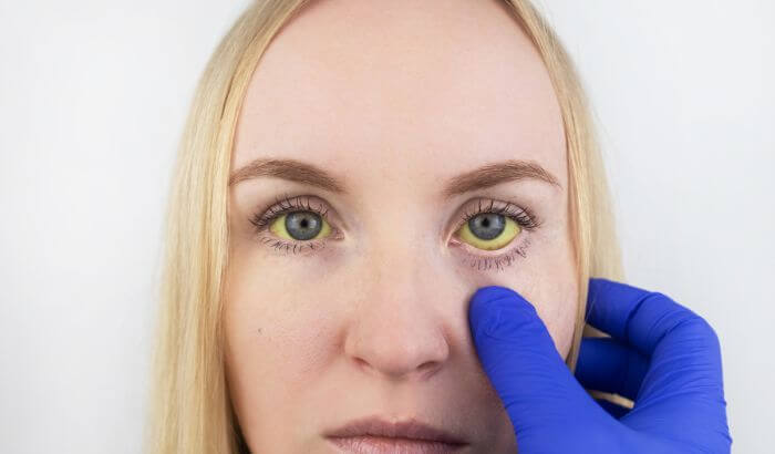 Olho amarelado no canto