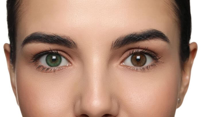 heterocromia parcial